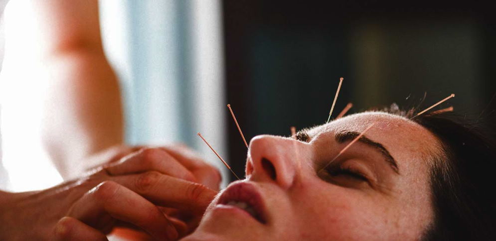acupuncture treatments